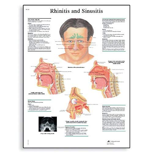 3B Scientific Lehrposter Rhinitis und Sinusitis Diagramm von 3B Scientific