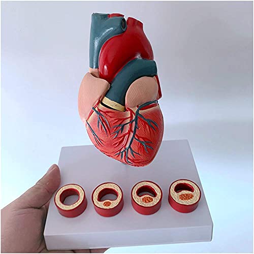 Anatomisches Modell des Herzens – Modell des menschlichen Herzens mit Blutblockade – Anatomisches, abnehmbares Struktur von Generic