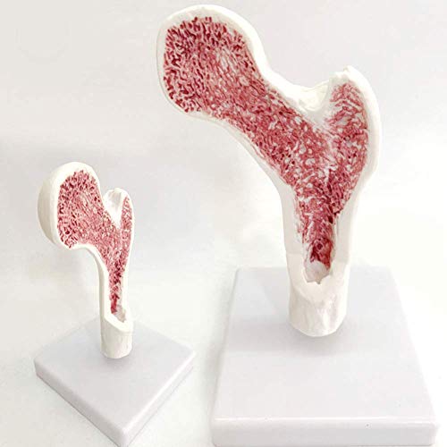 Anatomisches Modell des Menschen. Modell Einer menschlichen Femurerkrankung. Femur-Osteoporose-Skelett. Anatomisches Mod Anatomisches Modell des Menschen. Modell Einer menschlichen Femurerkrankung. Femur-Osteoporose-Skelett. Anatomisches Mod von Generic