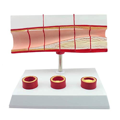 Bildungsmodell Koronare Herzkrankheit Medizinisches Modell Thromboseprozessmodell Anatomisches Modell des menschlichen von Generic