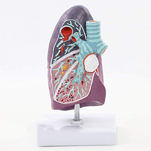 Lehrmodell Menschliche Lunge Anatomisches Modell Raucherpathologische Tuberkulose Lungenentzündung Thoraxchirurgie Atem von Generic