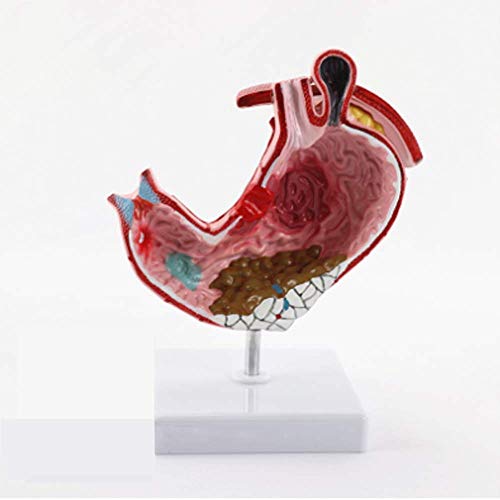 Lehrmodell des menschlichen Körpers, anatomisches Magenmodell, Demonstration von Magenpathologie-Krankheiten, Anatomiem von Generic