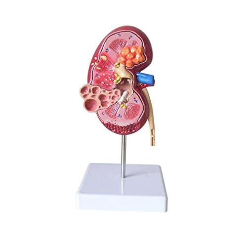 Pathologisches Modell, menschliches Nierenläsionsmodell, Anatomie, pathologisches Steinorgan, Nierensteine, Urologie, NI Pathologisches Modell, menschliches Nierenläsionsmodell, Anatomie, pathologisches Steinorgan, Nierensteine, Urologie, NI von Generic